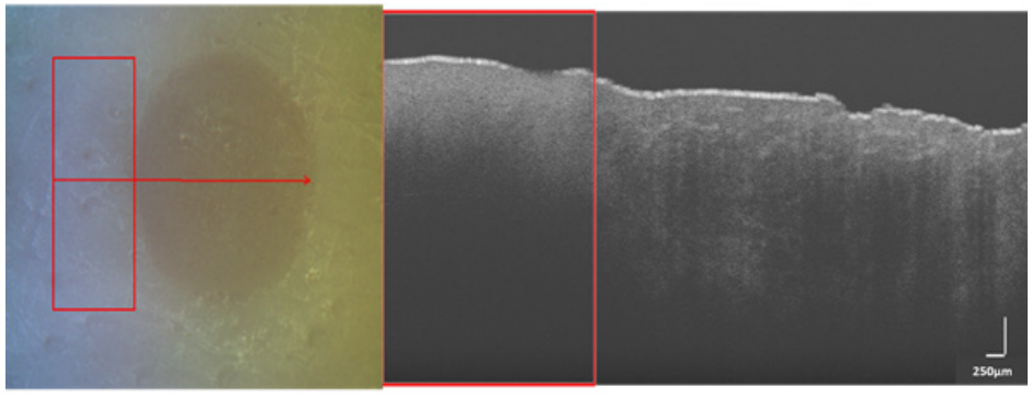 Figure 2. (left) White light image of a SPT burn with red arrow indicating linear scan region from left to right. (right) B-scan acquired from OCT (250 µm) over the region shown in left image. Rectangular red box in both images represents the control (normal) skin region and the region outside it covers burn portion.