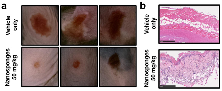 Figure 3. Nanosponges protect against group A streptococcus skin infection. (a) At three days post-infection, mice treated with nanosponges exhibited significantly reduced lesion sizes. (b) Histopathologic analysis of lesion biopsies showed that nanosponge-treated mice had less necrotic tissue injury compared with vehicle-treated mice [25]. (Reprinted with Permission)